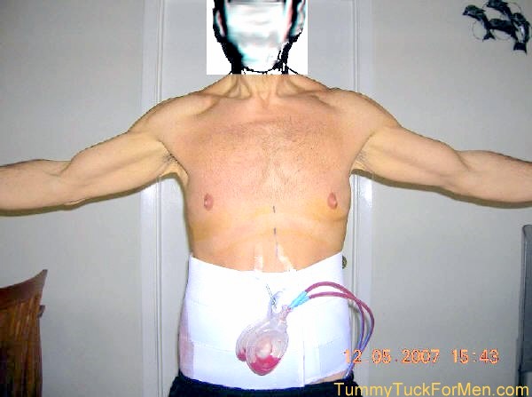 One Day After Tummy Tuck (Abdominoplasty) Plastic Surgery showing front view with compression garment and surgical drains. tummytuckformen.com